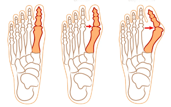 Halluks valgus deformitesi