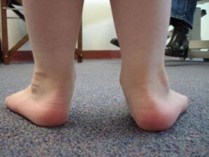 Çocukta düz valgus ayak deformitesi
